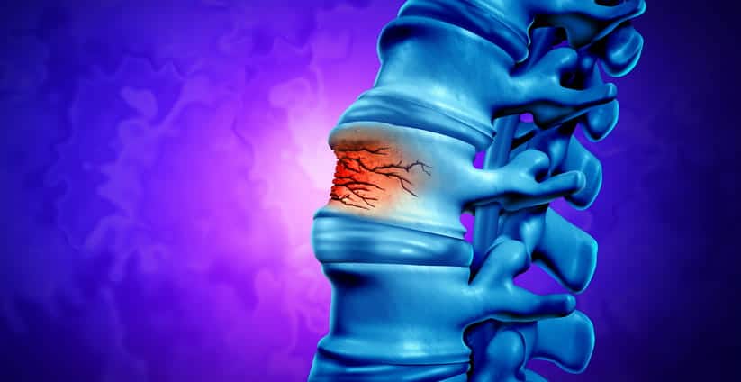 A graphic of a spinal cord injury.